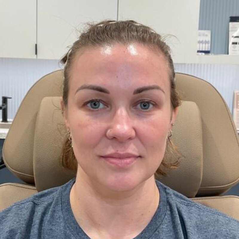 Dermal Fillers Before & After Image
