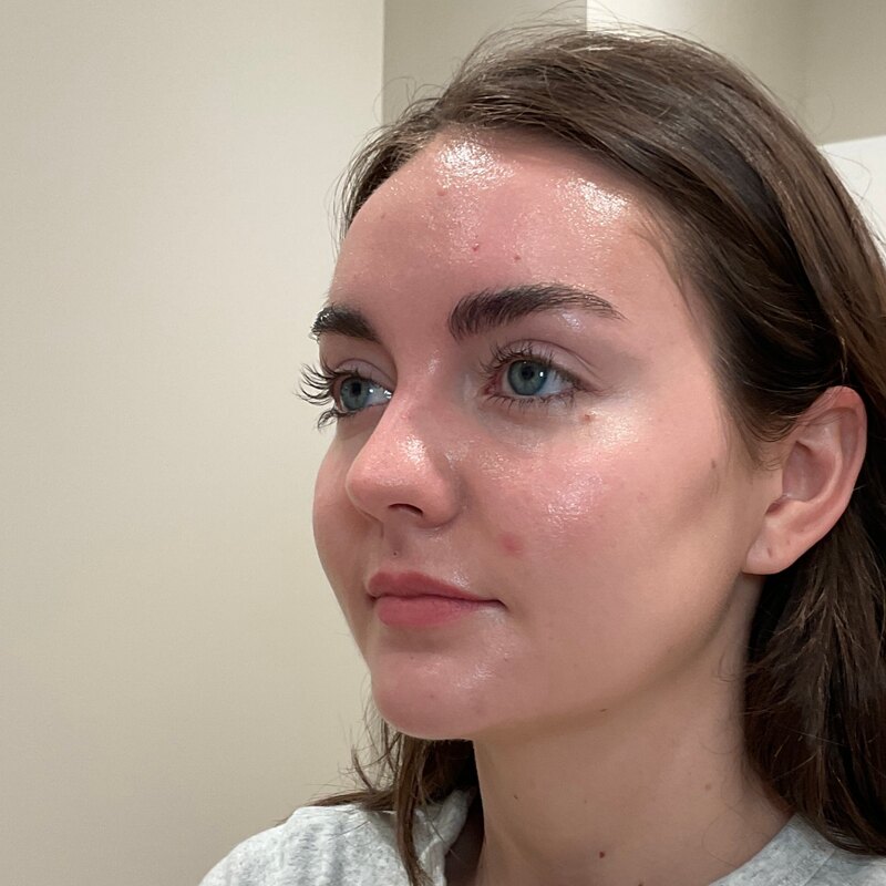 Dermal Fillers Before & After Image