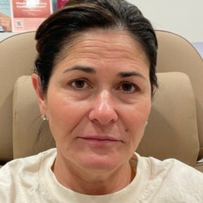 Dermal Fillers Before & After Image