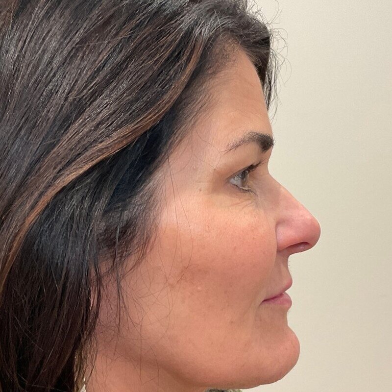 Dermal Fillers Before & After Image