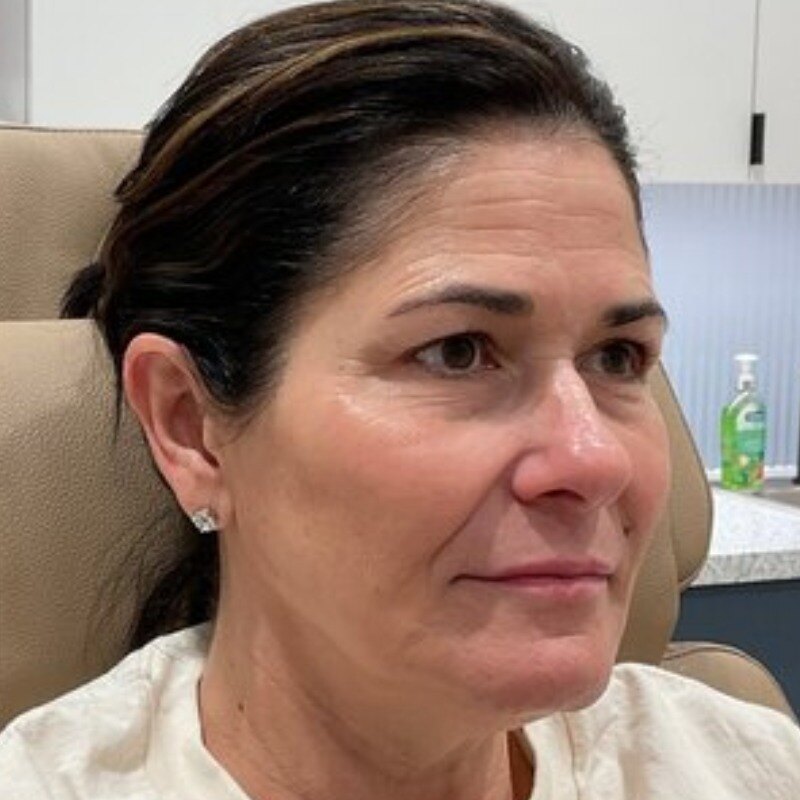 Dermal Fillers Before & After Image
