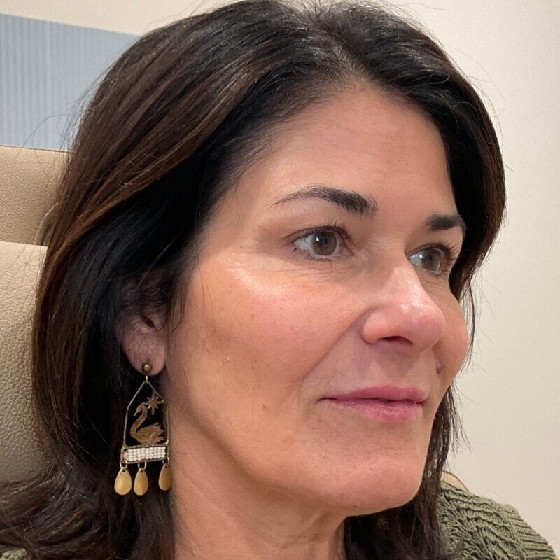 Dermal Fillers Before & After Image