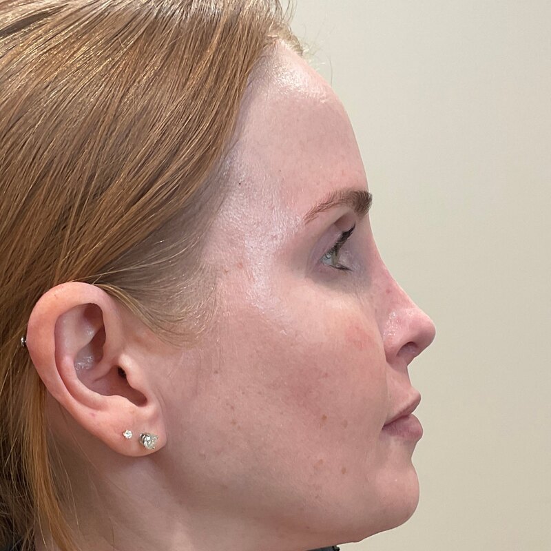 Dermal Fillers Before & After Image