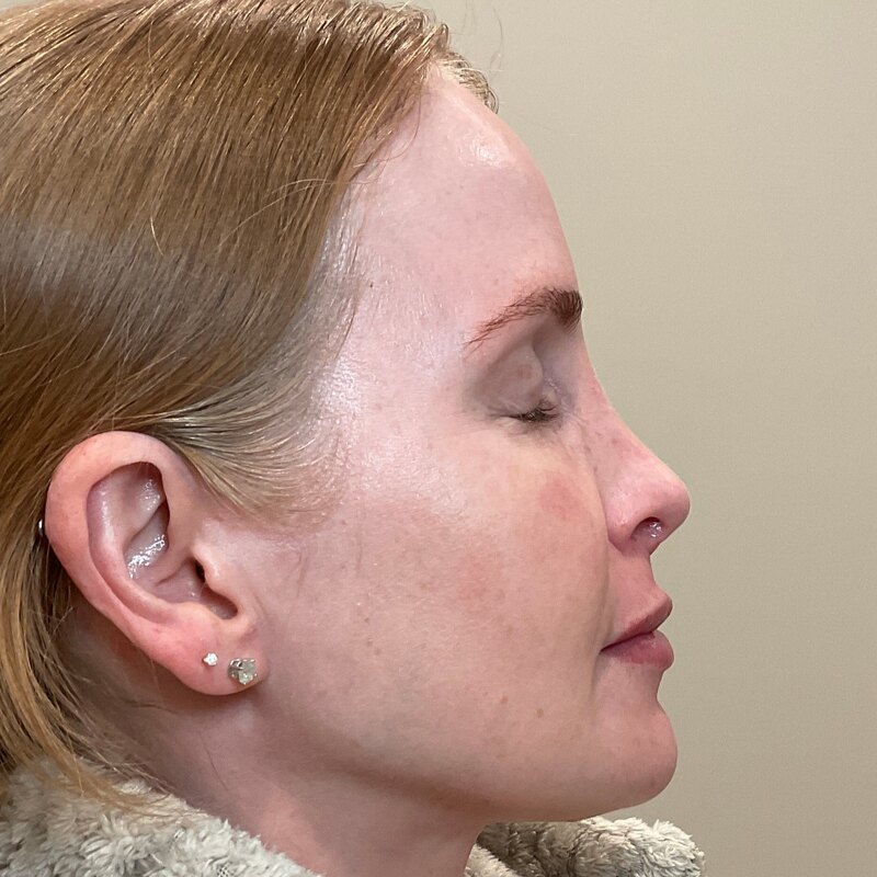 Dermal Fillers Before & After Image