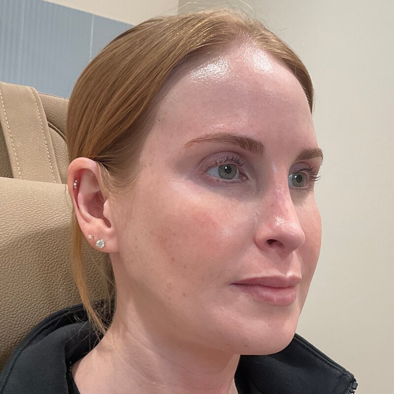 Dermal Fillers Before & After Image
