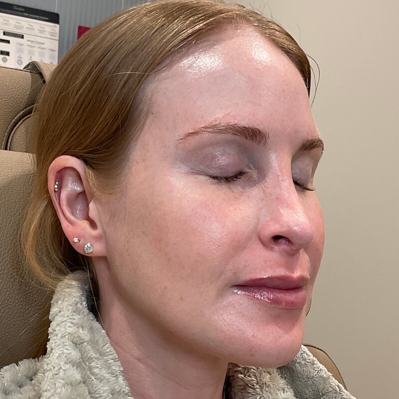 Dermal Fillers Before & After Image