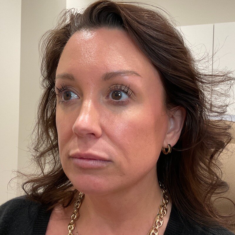 Dermal Fillers Before & After Image