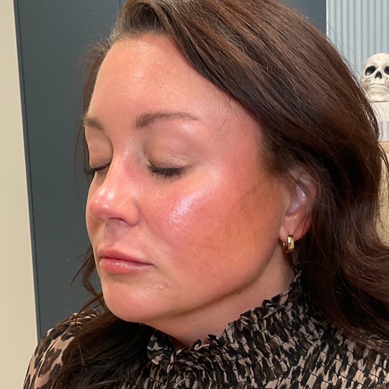 Dermal Fillers Before & After Image