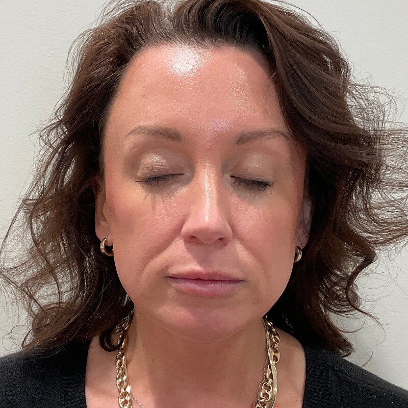 Dermal Fillers Before & After Image
