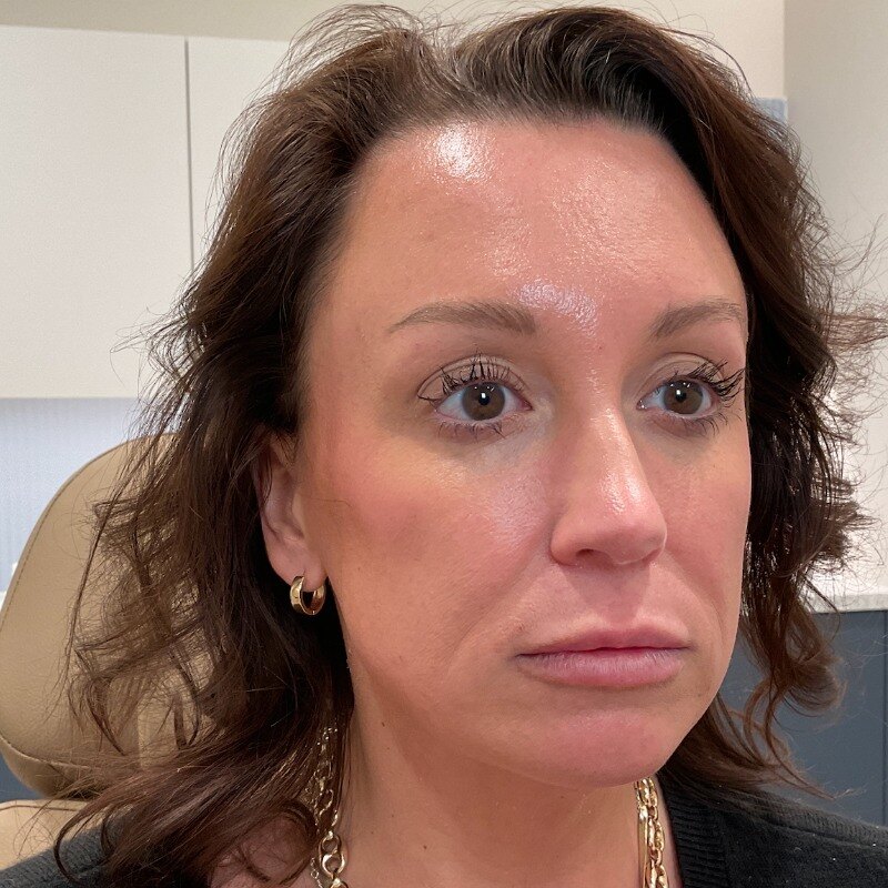 Dermal Fillers Before & After Image
