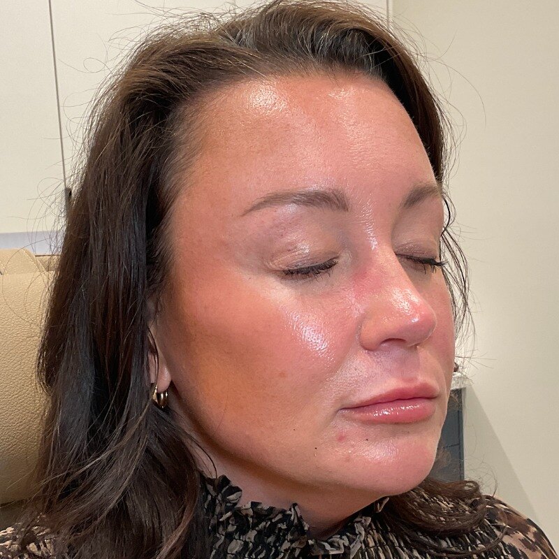 Dermal Fillers Before & After Image
