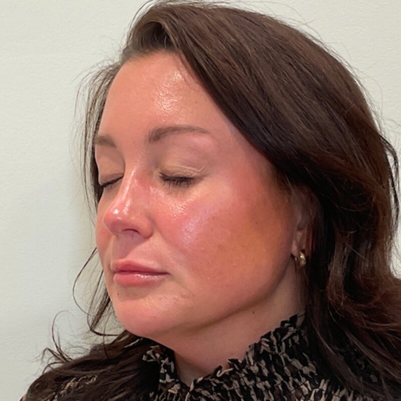 Dermal Fillers Before & After Image