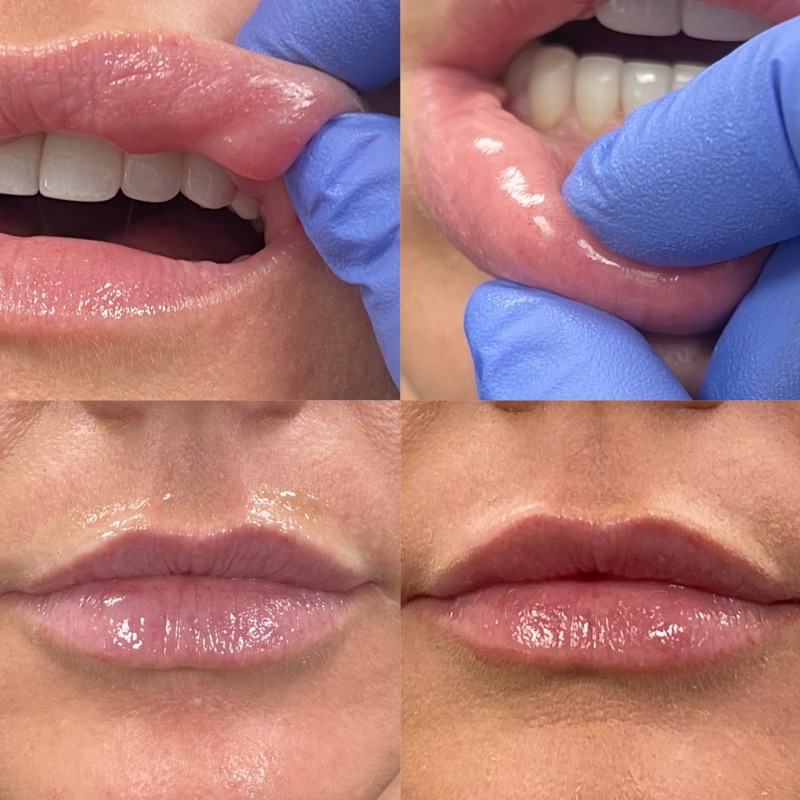 Filler Dissolver Before & After Image