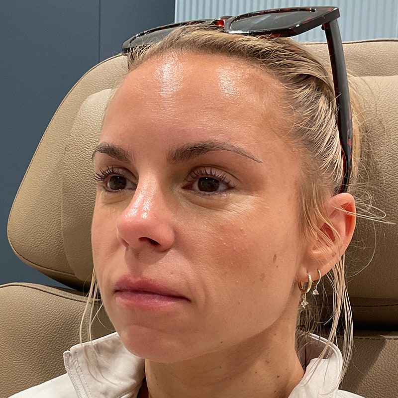 Full Facial Balancing Before & After Image