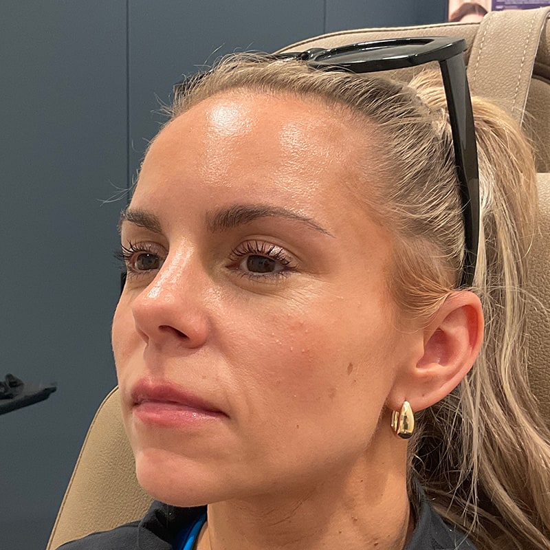 Full Facial Balancing Before & After Image