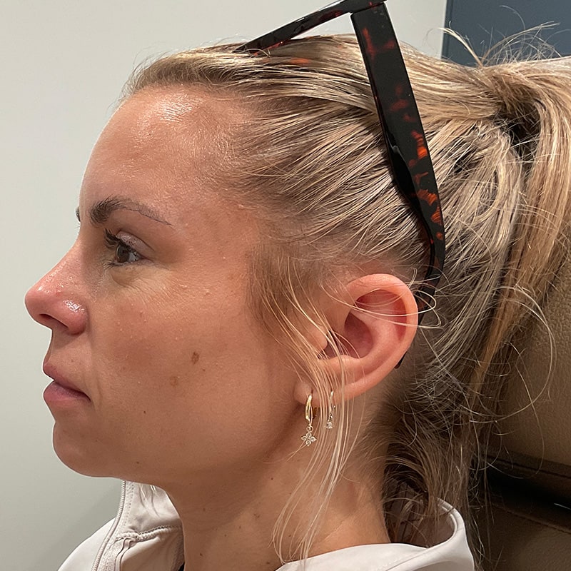 Full Facial Balancing Before & After Image