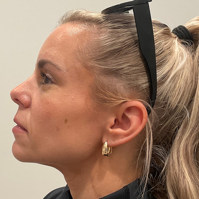 Full Facial Balancing Before & After Image