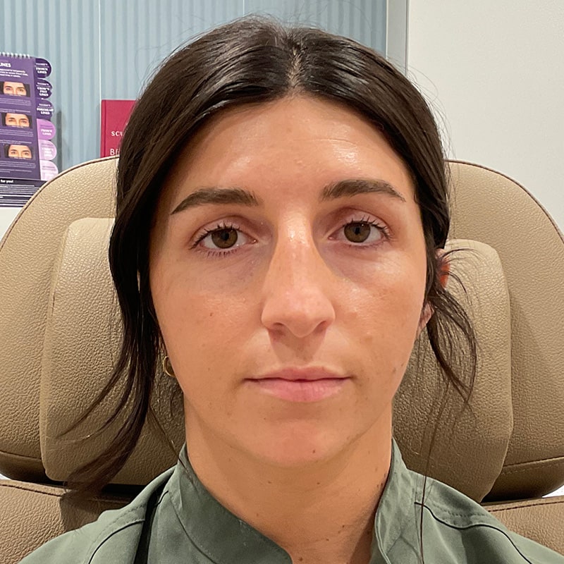 Full Facial Balancing Before & After Image