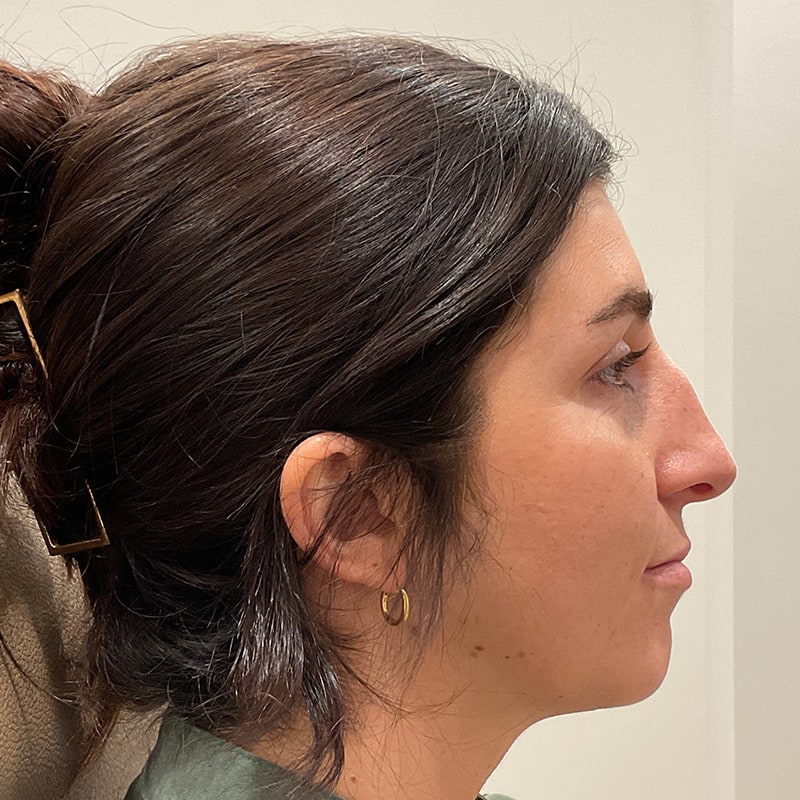 Full Facial Balancing Before & After Image