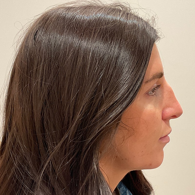 Full Facial Balancing Before & After Image