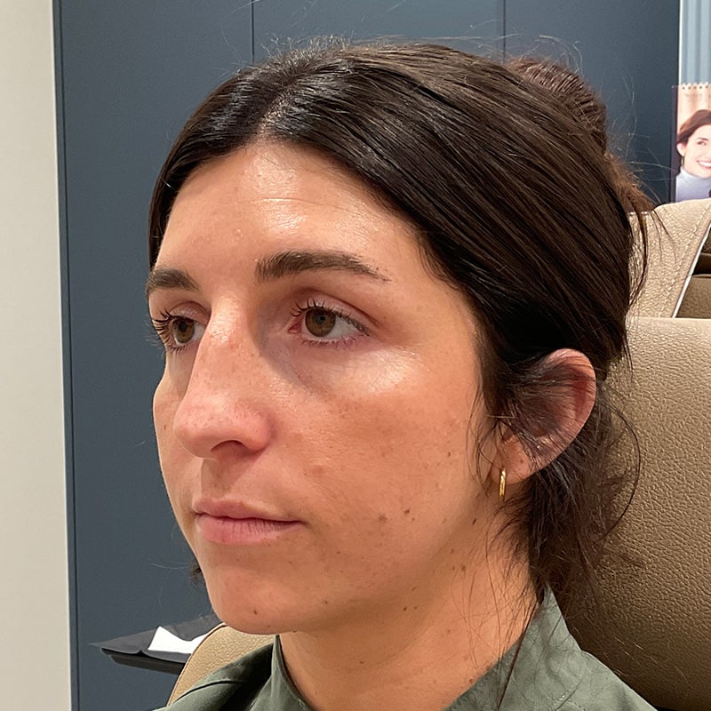 Full Facial Balancing Before & After Image