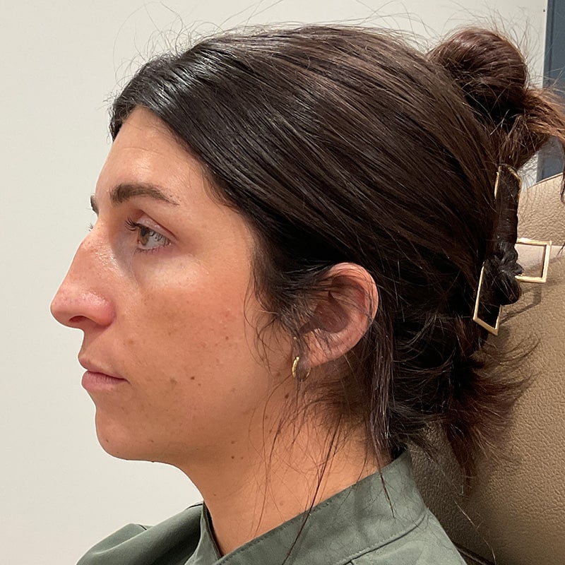 Full Facial Balancing Before & After Image