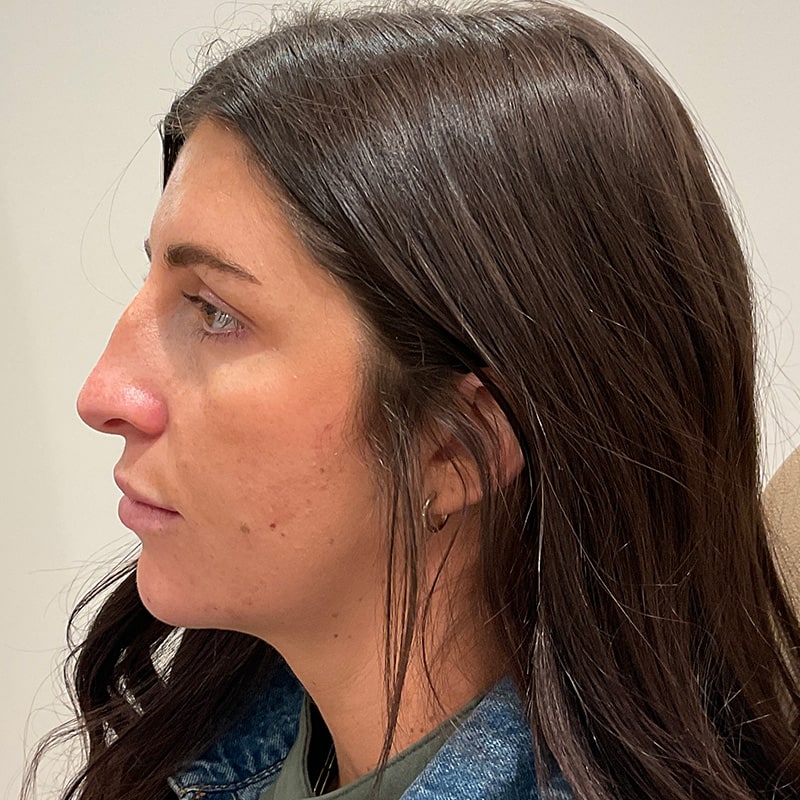 Full Facial Balancing Before & After Image