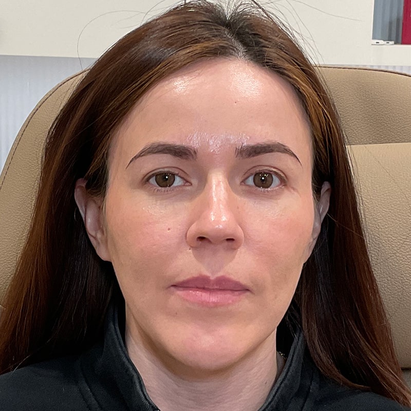 Full Facial Balancing Before & After Image