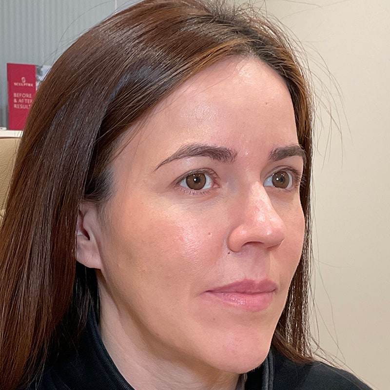 Full Facial Balancing Before & After Image