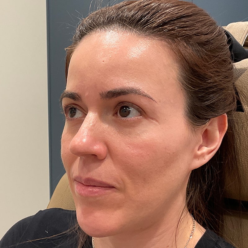 Full Facial Balancing Before & After Image