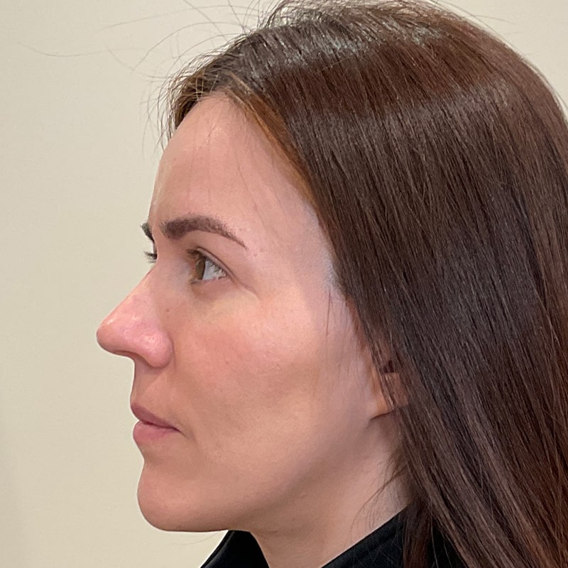 Full Facial Balancing Before & After Image