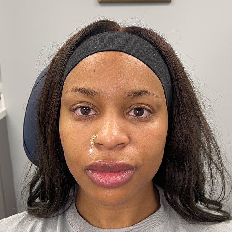 Full Facial Balancing Before & After Image