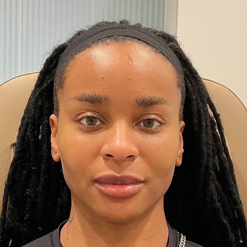 Full Facial Balancing Before & After Image