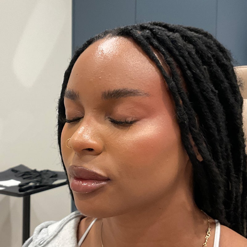 Full Facial Balancing Before & After Image