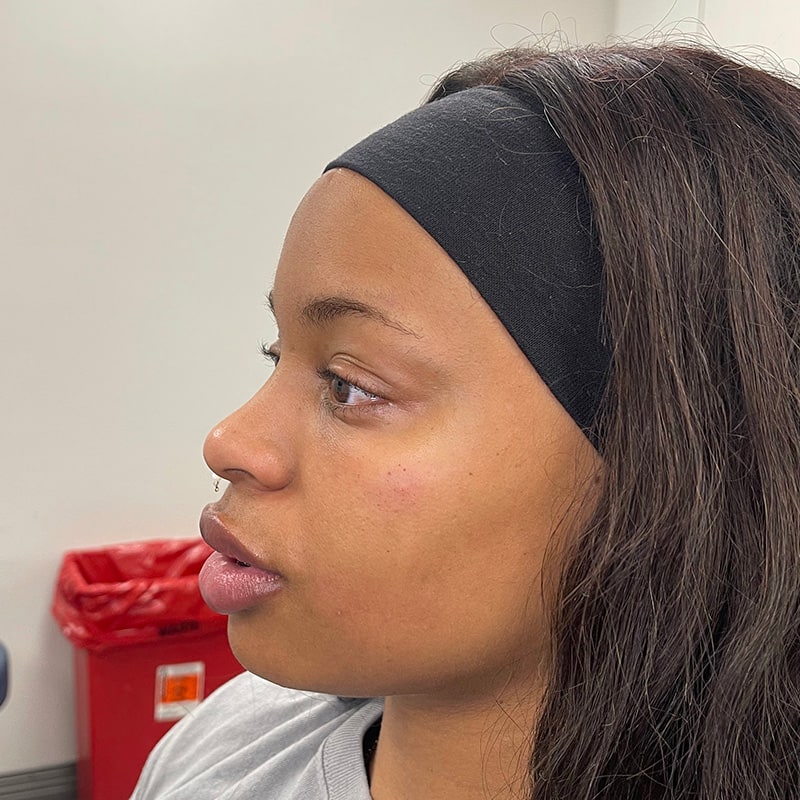 Full Facial Balancing Before & After Image