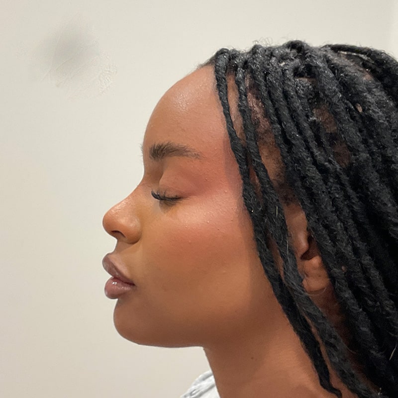 Full Facial Balancing Before & After Image