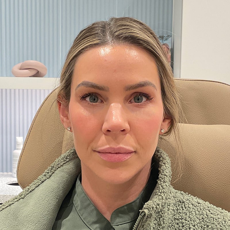 Full Facial Balancing Before & After Image