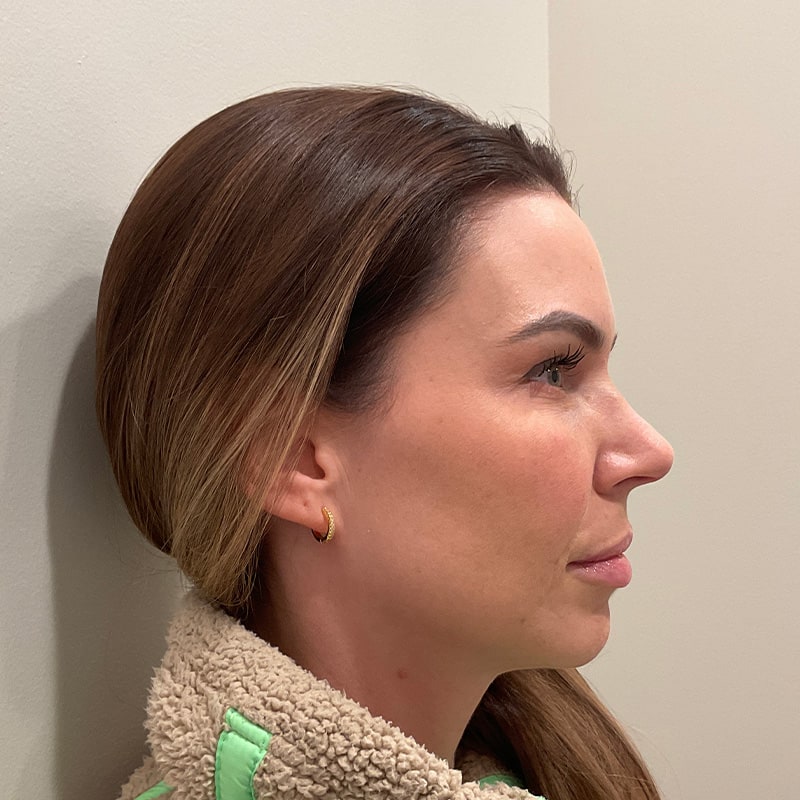 Full Facial Balancing Before & After Image