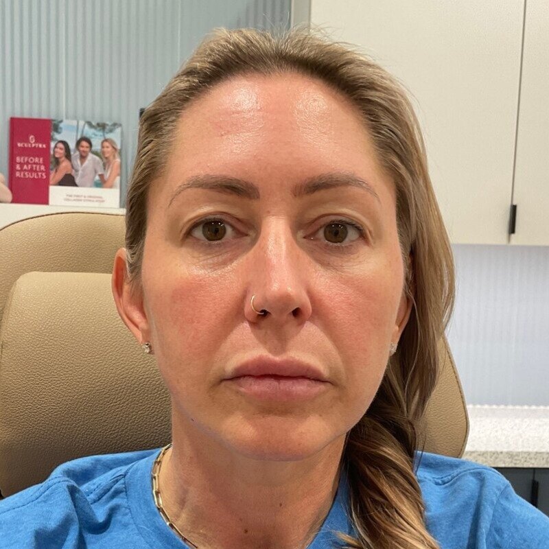 Full Facial Balancing Before & After Image