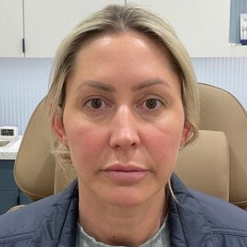 Full Facial Balancing Before & After Image