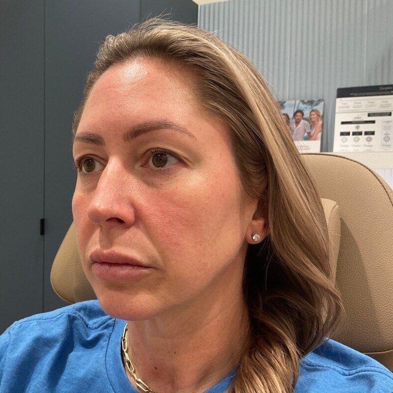 Full Facial Balancing Before & After Image
