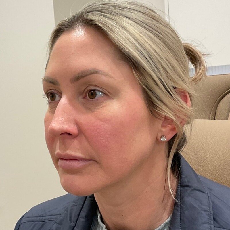 Full Facial Balancing Before & After Image