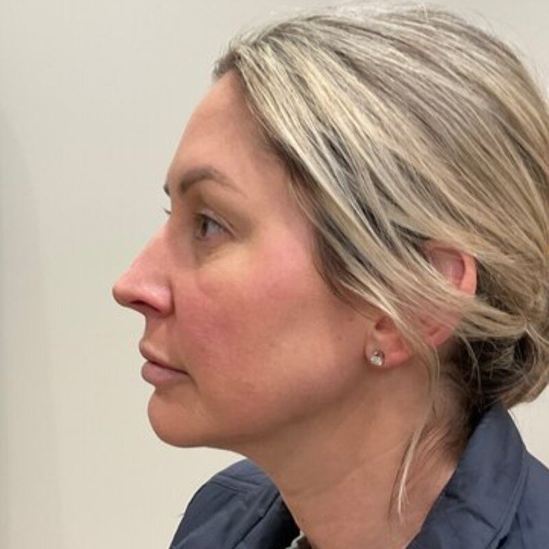 Full Facial Balancing Before & After Image