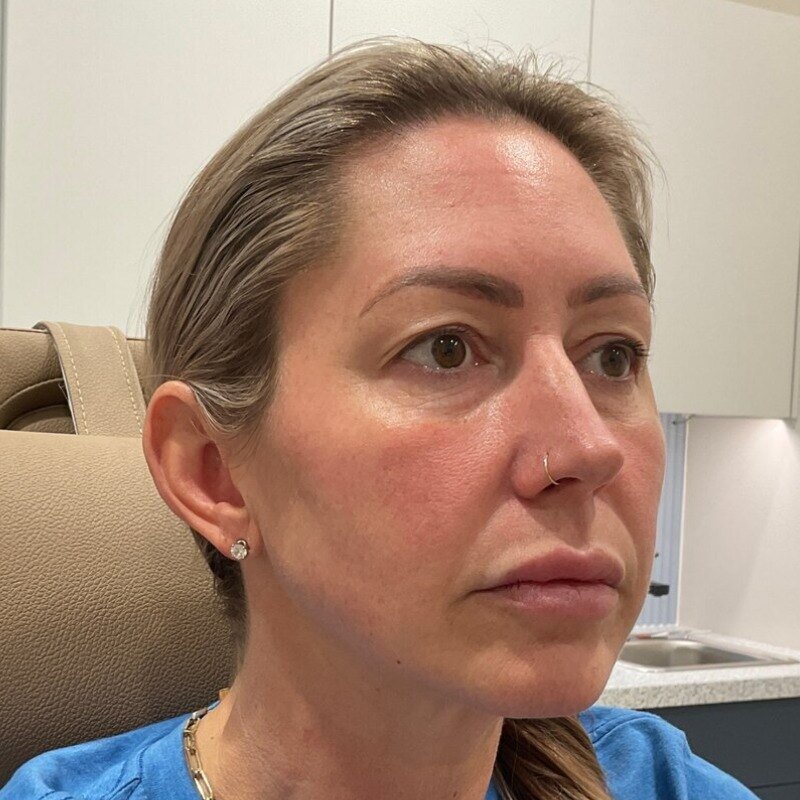 Full Facial Balancing Before & After Image