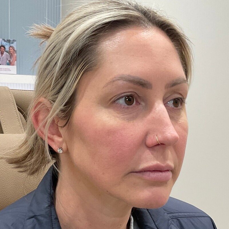 Full Facial Balancing Before & After Image