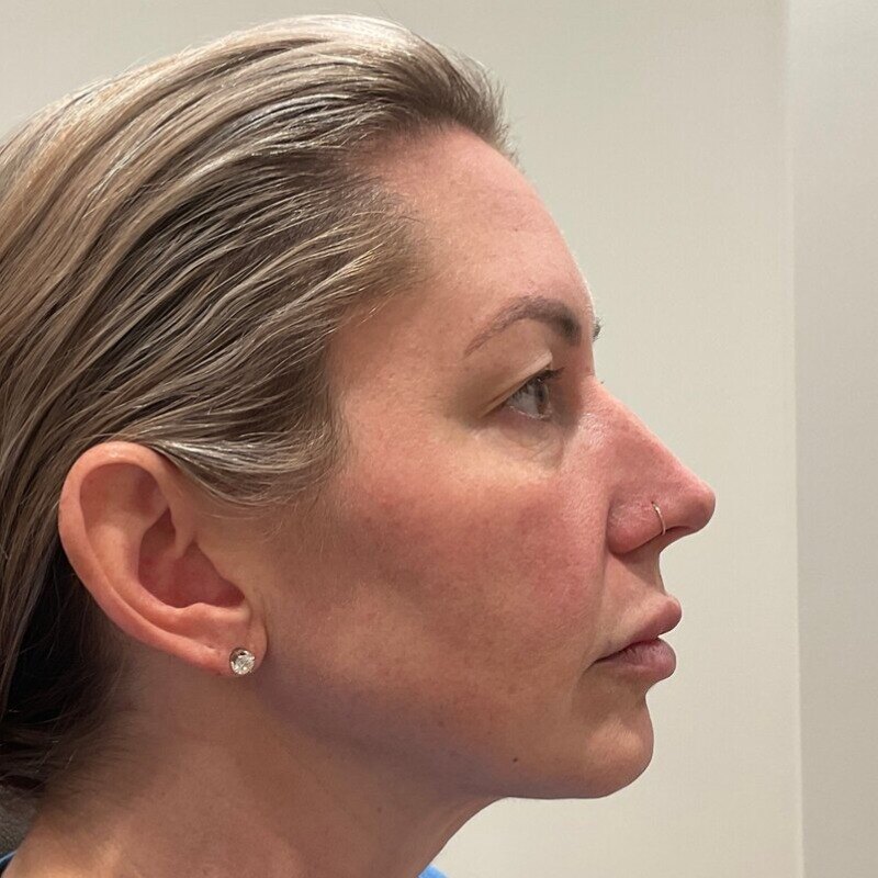 Full Facial Balancing Before & After Image