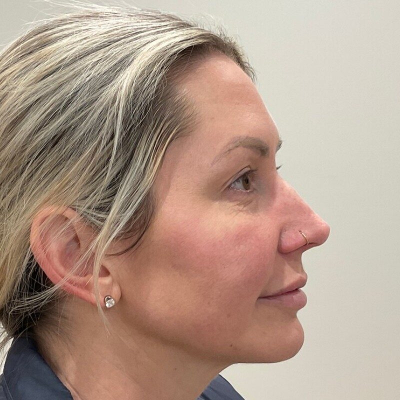 Full Facial Balancing Before & After Image
