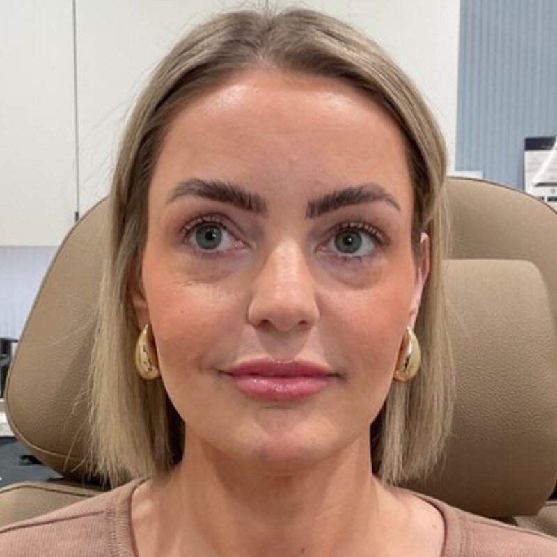 Full Facial Balancing Before & After Image