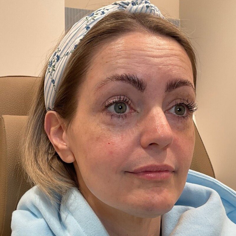 Full Facial Balancing Before & After Image