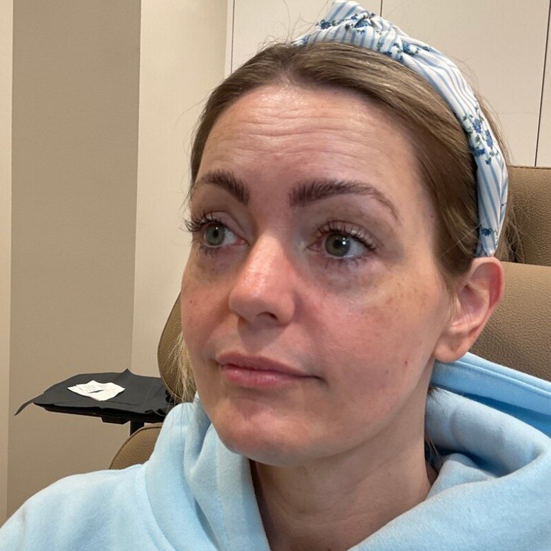 Full Facial Balancing Before & After Image